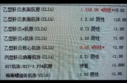 湖北鄂州发现1例阳性感染者（艾滋病病人和艾滋病病毒感染者阳性）