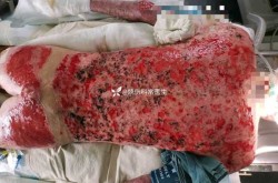 全国各城市高峰感染进度，烧伤感染期有三个高峰分别是什么
