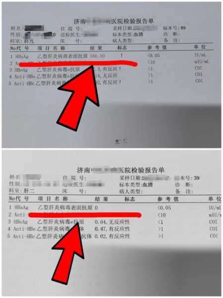 官方:抗原检测可能出现假阴假阳(乙肝表面抗原假阳性)
