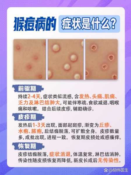 中国大陆猴痘病例已达10例(中国大陆猴痘传播途径)