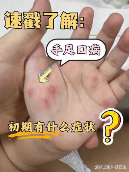 传染了性疾病有哪些症状，女人得了性疾病的症状