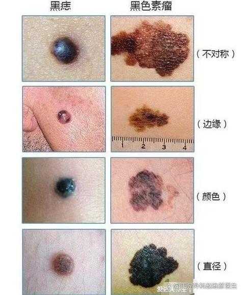 黑色素肿瘤是一种什么病，黑色素肿瘤的成因是什么