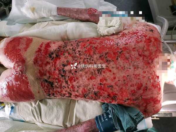 全国各城市高峰感染进度，烧伤感染期有三个高峰分别是什么